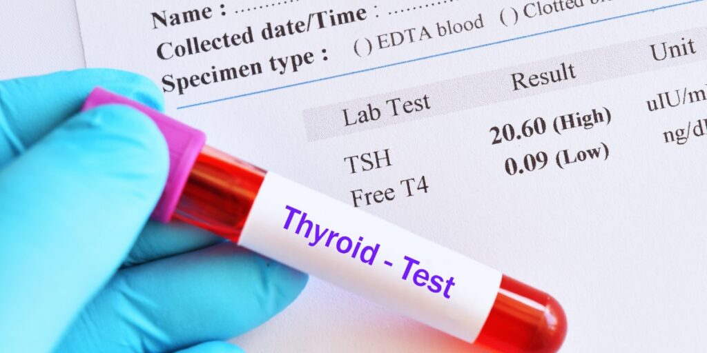 Diagnóstico do hipotireodismo